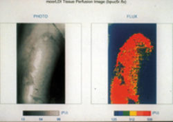 Fig. 2 : LDI (Laser Doppler Imaging)