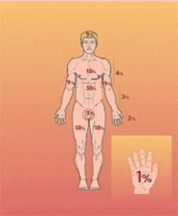 Fig. 7: Règle de 9 (Wallace)